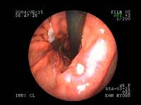 経鼻内視鏡検査（胃カメラ）